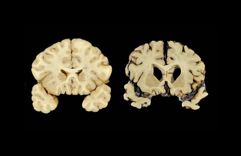 Faces of CTE - Michael Lewis Mike Webster (March 18, 1952